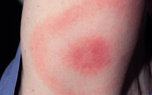 Ring-shaped erythema migrans rash on the back of an upper arm, CDC clinical reference photo