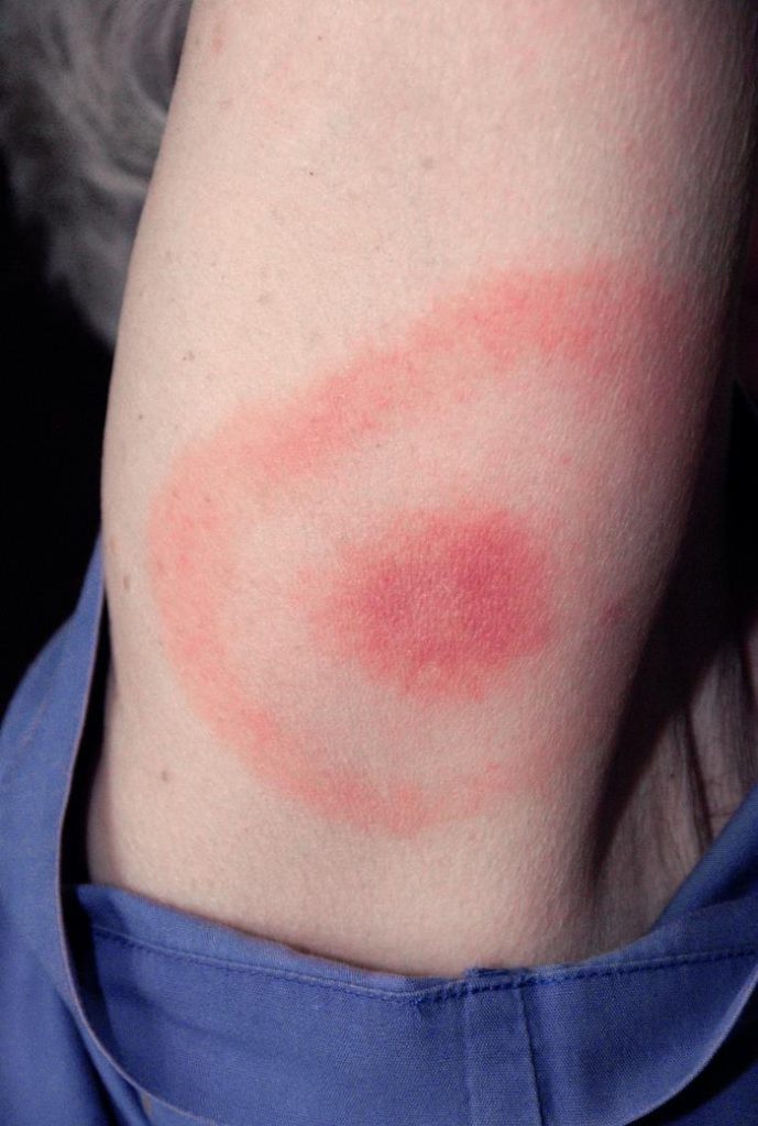 Ring-shaped erythema migrans rash on the back of an upper arm, CDC clinical reference photo