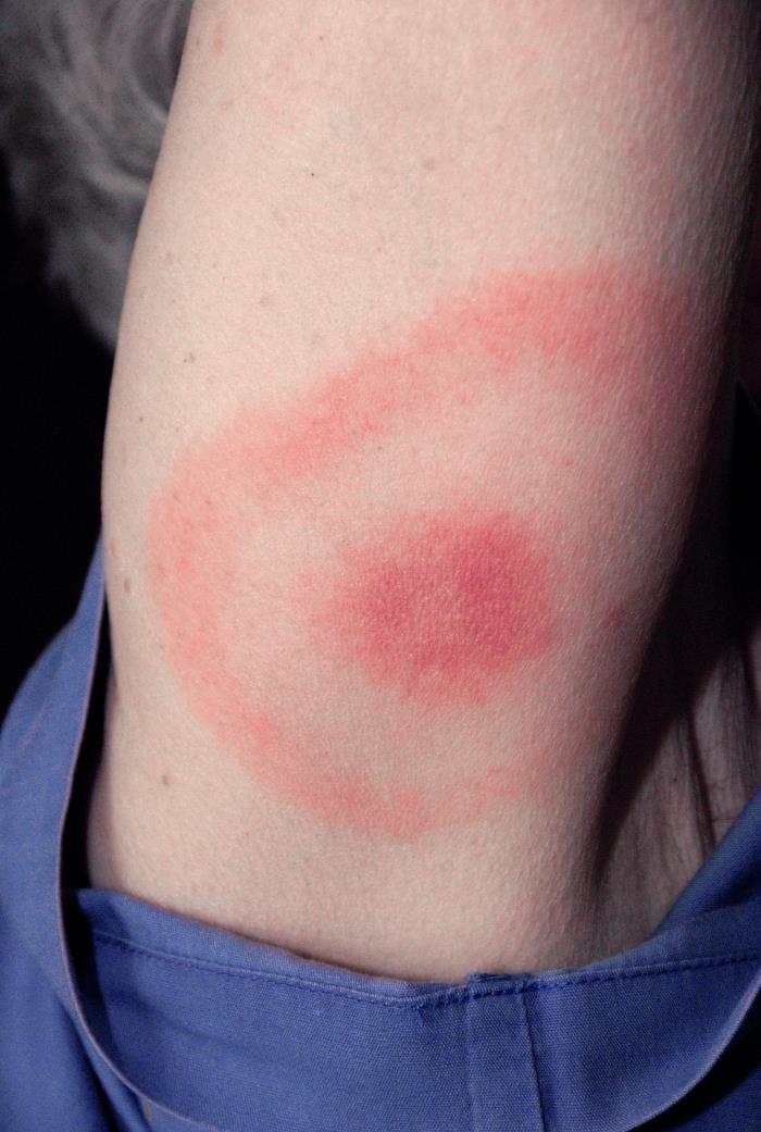 Ring-shaped erythema migrans rash on the back of an upper arm, CDC clinical reference photo