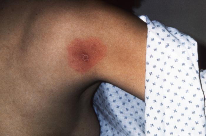 Erythema migrans rash on the back of a shoulder, CDC clinical reference photo